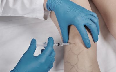 علاج دوالي الساقين بالحقن الرغوي